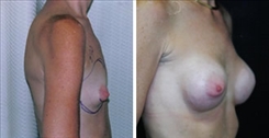 Tubular Breast Deformity Patient Before & After Photo 1