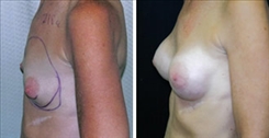 Tubular Breast Deformity Patient Before & After Photo 1