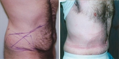 Procedures for Men Patient Before & After Photo 1