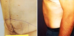 Tummy Tuck for Men Patient Before & After Photo 1