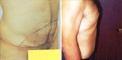 Tummy Tuck for Men Patient Before & After Photo 1