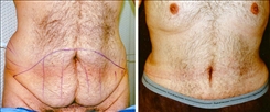 Tummy Tuck for Men Patient Before & After Photo 1
