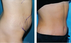 Tummy Tuck Patient Before & After Photo 1