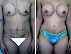 Tummy Tuck Patient Before & After Photo 1