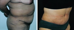 Tummy Tuck Patient Before & After Photo 1