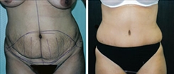 Tummy Tuck Patient Before & After Photo 1