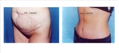 Tummy Tuck Patient Before & After Photo 1