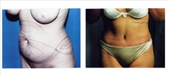 Tummy Tuck Patient Before & After Photo 1