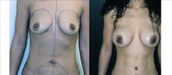 Tummy Tuck Patient Before & After Photo 1