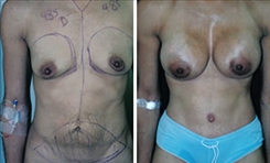 Tummy Tuck Patient Before & After Photo 1