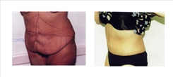 Tummy Tuck Patient Before & After Photo 1