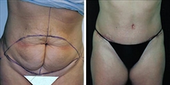 Tummy Tuck Patient Before & After Photo 1