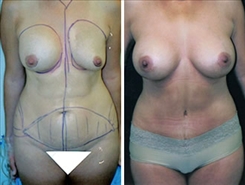 Tummy Tuck Patient Before & After Photo 1