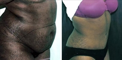 Tummy Tuck Patient Before & After Photo 1