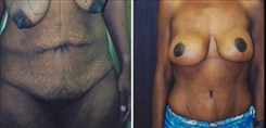 Tummy Tuck Patient Before & After Photo 1