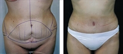 Tummy Tuck Patient Before & After Photo 1