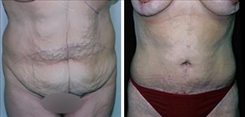 Tummy Tuck Patient Before & After Photo 1