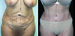 Tummy Tuck Patient Before & After Photo 1