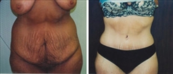 Tummy Tuck Patient Before & After Photo 1