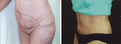 Tummy Tuck Patient Before & After Photo 1