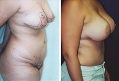 Tummy Tuck Patient Before & After Photo 1