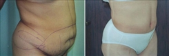 Tummy Tuck Patient Before & After Photo 1