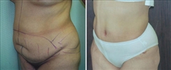 Tummy Tuck Patient Before & After Photo 1