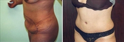 Tummy Tuck Patient Before & After Photo 1