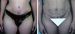 Tummy Tuck Patient Before & After Photo 1