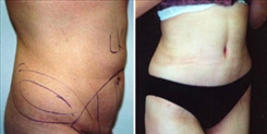 Tummy Tuck Patient Before & After Photo 1