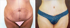 Tummy Tuck Patient Before & After Photo 1