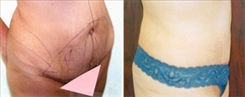 Tummy Tuck Patient Before & After Photo 1