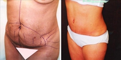 Body Procedures Patient Before & After Photo 1