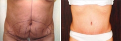 Tummy Tuck Patient Before & After Photo 1