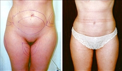 Tummy Tuck Patient Before & After Photo 1