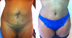 Body Procedures Patient Before & After Photo 1