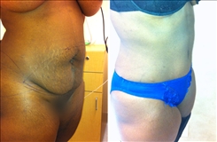 Body Procedures Patient Before & After Photo 1