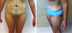 Tummy Tuck Patient Before & After Photo 1