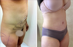 Tummy Tuck Patient Before & After Photo 1