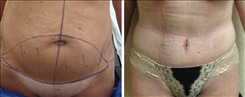 Tummy Tuck Patient Before & After Photo 1