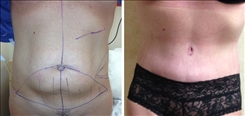 Body Procedures Patient Before & After Photo 1