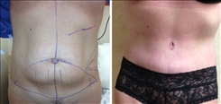 Tummy Tuck Patient Before & After Photo 1