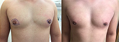 Procedures for Men Patient Before & After Photo 1