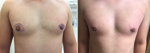 gynecomastia before and after