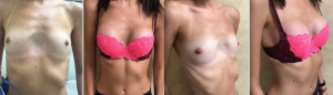 PECTUS EXCAVATUM BREAST AUGMENTATION