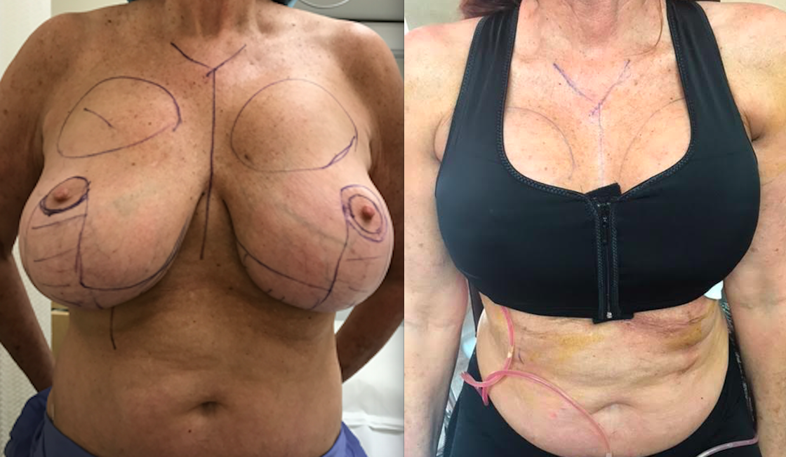Breast Implant Removal In Dallas, Tx