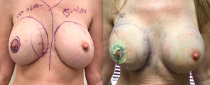 breast revision and lift 