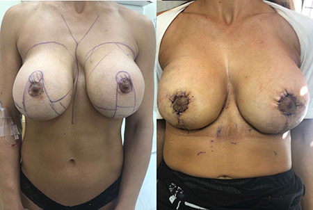 Before and After Breast Revision - Patient 1