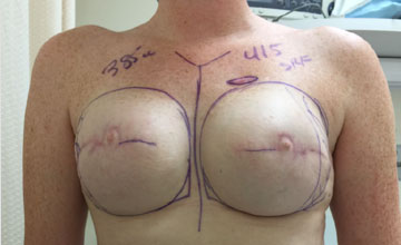 Before Breast Reconstruction 01