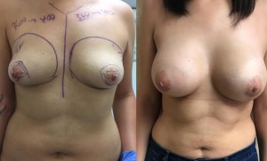 before and after tubular breast augmentation 